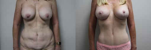 mommy makeover before and after photos by kryger institute of plastic surgery in thousand oaks ca