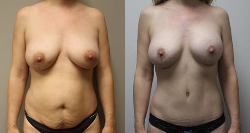 mommy makeover before and after photos by kryger institute of plastic surgery in thousand oaks ca