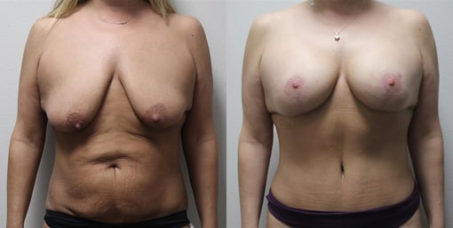 mommy makeover before and after photos by kryger institute of plastic surgery in thousand oaks ca