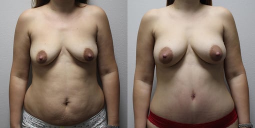 mommy makeover before and after photos by kryger institute of plastic surgery in thousand oaks ca