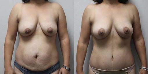 mommy makeover before and after photos by kryger institute of plastic surgery in thousand oaks ca