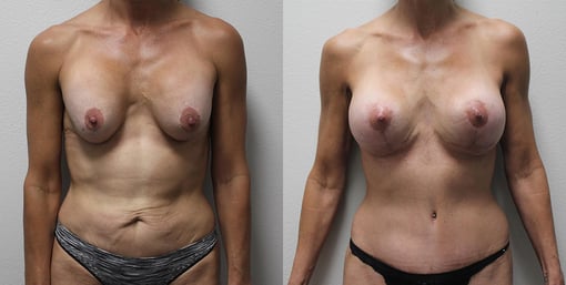 mommy makeover before and after photos by kryger institute of plastic surgery in thousand oaks ca