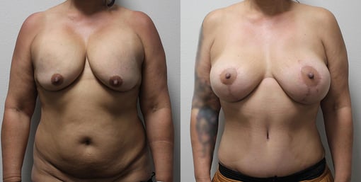 mommy makeover before and after photos by kryger institute of plastic surgery in thousand oaks ca