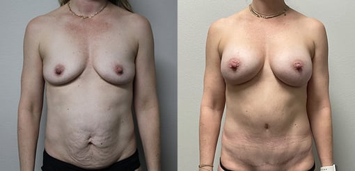 mommy makeover before and after photos by kryger institute of plastic surgery in thousand oaks ca
