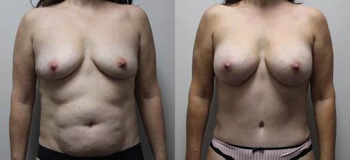 mommy makeover before and after photos by kryger institute of plastic surgery in thousand oaks ca
