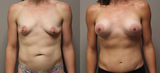 mommy makeover before and after photos by kryger institute of plastic surgery in thousand oaks ca