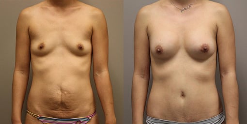mommy makeover before and after photos by kryger institute of plastic surgery in thousand oaks ca