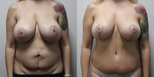 mommy makeover before and after photos by kryger institute of plastic surgery in thousand oaks ca