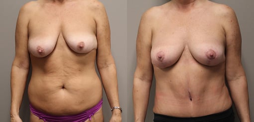 mommy makeover before and after photos by kryger institute of plastic surgery in thousand oaks ca