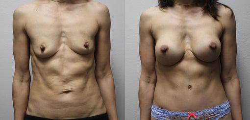 mommy makeover before and after photos by kryger institute of plastic surgery in thousand oaks ca