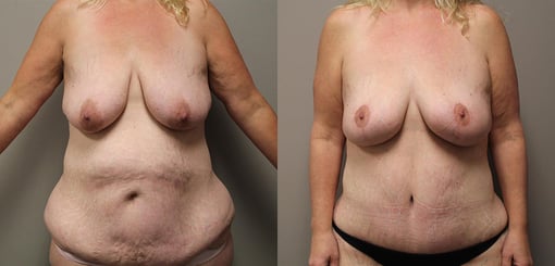 mommy makeover before and after photos by kryger institute of plastic surgery in thousand oaks ca