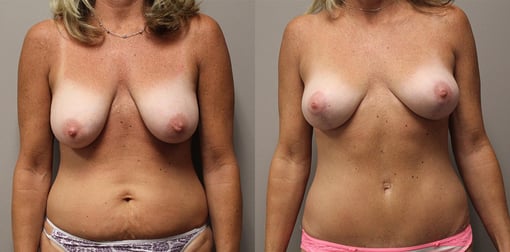 mommy makeover before and after photos by kryger institute of plastic surgery in thousand oaks ca