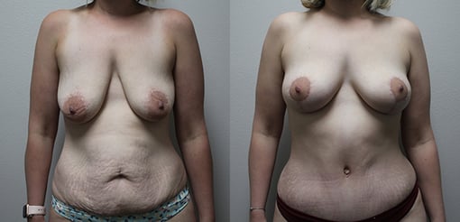 mommy makeover before and after photos by kryger institute of plastic surgery in thousand oaks ca