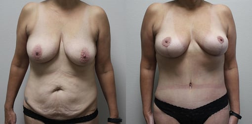 mommy makeover before and after photos by kryger institute of plastic surgery in thousand oaks ca