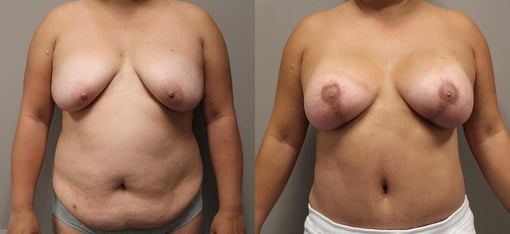 mommy makeover before and after photos by kryger institute of plastic surgery in thousand oaks ca