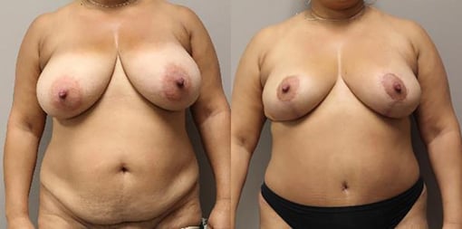 mommy makeover before and after photos by kryger institute of plastic surgery in thousand oaks ca
