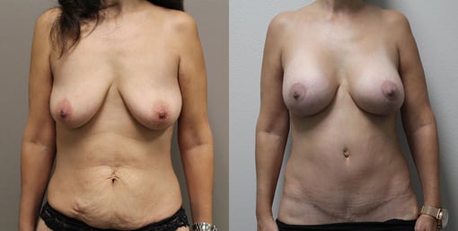 mommy makeover before and after photos by kryger institute of plastic surgery in thousand oaks ca