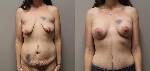 mommy makeover before and after photos by kryger institute of plastic surgery in thousand oaks ca