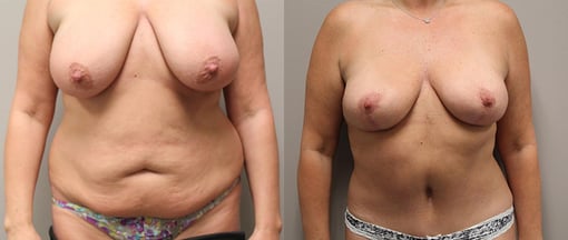 mommy makeover before and after photos by kryger institute of plastic surgery in thousand oaks ca