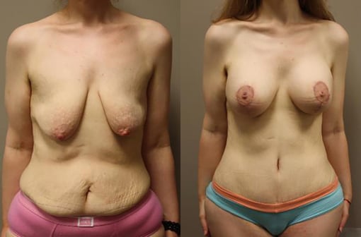 mommy makeover before and after photos by kryger institute of plastic surgery in thousand oaks ca