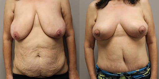 mommy makeover before and after photos by kryger institute of plastic surgery in thousand oaks ca