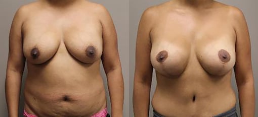 mommy makeover before and after photos by kryger institute of plastic surgery in thousand oaks ca