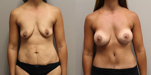 mommy makeover before and after photos by kryger institute of plastic surgery in thousand oaks ca