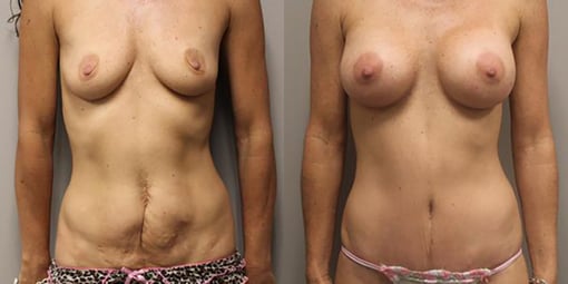mommy makeover before and after photos by kryger institute of plastic surgery in thousand oaks ca