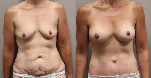 mommy makeover before and after photos by kryger institute of plastic surgery in thousand oaks ca