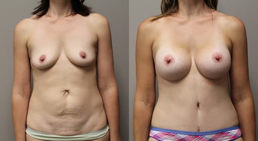 mommy makeover before and after photos by kryger institute of plastic surgery in thousand oaks ca