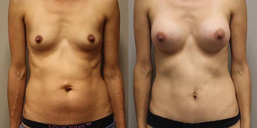 mommy makeover before and after photos by kryger institute of plastic surgery in thousand oaks ca