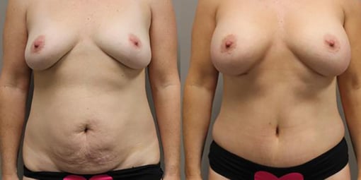 mommy makeover before and after photos by kryger institute of plastic surgery in thousand oaks ca