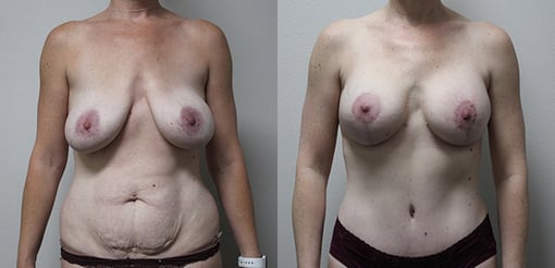 mommy makeover before and after photos by kryger institute of plastic surgery in thousand oaks ca