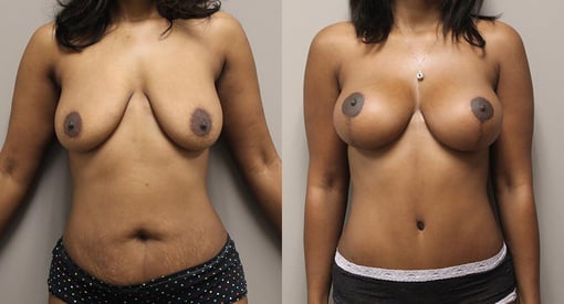 mommy makeover before and after photos by kryger institute of plastic surgery in thousand oaks ca