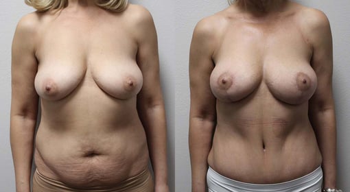 mommy makeover before and after photos by kryger institute of plastic surgery in thousand oaks ca