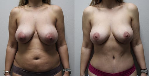 mommy makeover before and after photos by kryger institute of plastic surgery in thousand oaks ca