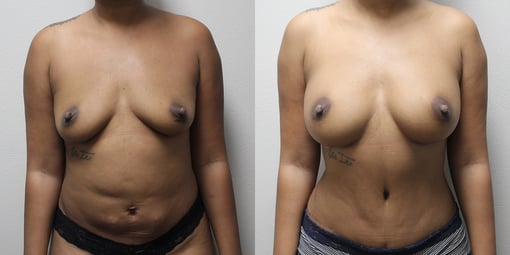 mommy makeover before and after photos by kryger institute of plastic surgery in thousand oaks ca