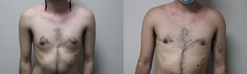 male breast reduction before and after photos by kryger institute of plastic surgery in thousand oaks ca