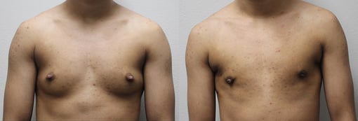 male breast reduction before and after photos by kryger institute of plastic surgery in thousand oaks ca