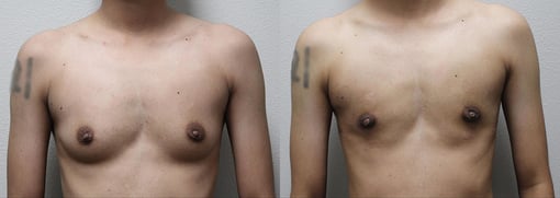 male breast reduction before and after photos by kryger institute of plastic surgery in thousand oaks ca