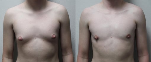 male breast reduction before and after photos by kryger institute of plastic surgery in thousand oaks ca