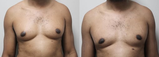 male breast reduction before and after photos by kryger institute of plastic surgery in thousand oaks ca