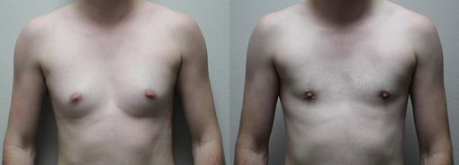 male breast reduction before and after photos by kryger institute of plastic surgery in thousand oaks ca