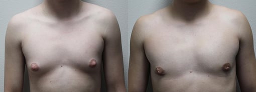 male breast reduction before and after photos by kryger institute of plastic surgery in thousand oaks ca