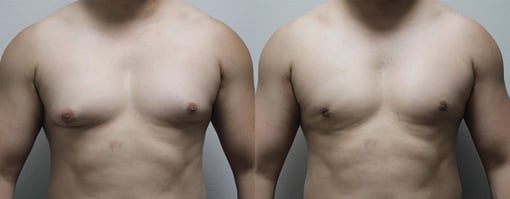 male breast reduction before and after photos by kryger institute of plastic surgery in thousand oaks ca