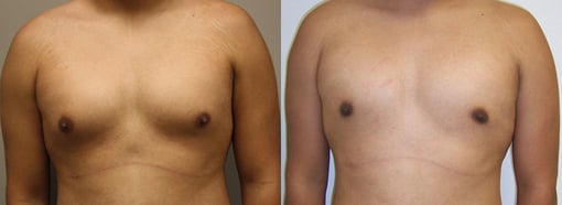 male breast reduction before and after photos by kryger institute of plastic surgery in thousand oaks ca