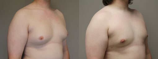 male breast reduction before and after photos by kryger institute of plastic surgery in thousand oaks ca
