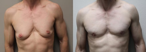 male breast reduction before and after photos by kryger institute of plastic surgery in thousand oaks ca