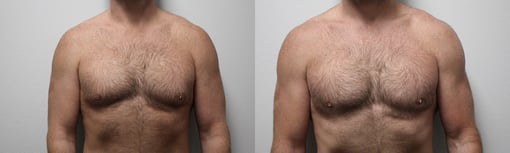 male breast reduction before and after photos by kryger institute of plastic surgery in thousand oaks ca