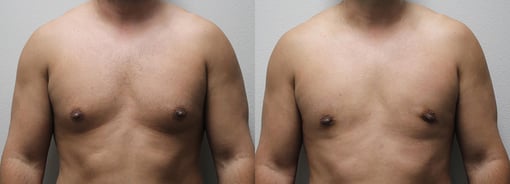 male breast reduction before and after photos by kryger institute of plastic surgery in thousand oaks ca